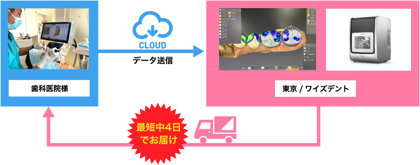 歯科医院様で口腔内を直接スキャン。クラウドを経由してワイズデントへデータを送信します。ワイズデントではデータを受け取った後、データを元に設計およびミリングマシーンで製作をし、最短中4日で歯科医院様にお届けします。